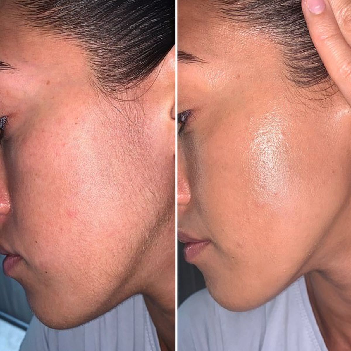 Dermalisse™ - Une épilation du visage douce pour une peau lisse et lumineuse